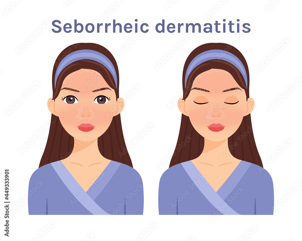 Seborrheic dermatitis. Isolated Beautiful Brunette woman. Cute face. Skin disease. Woman with open eyes and closed. White background. Color Flat cartoon illustration. Vector stock illustration.