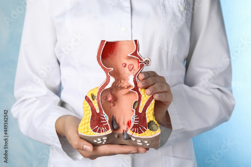 Doctor holding model of unhealthy lower rectum on light blue background, closeup. Hemorrhoid problem photo