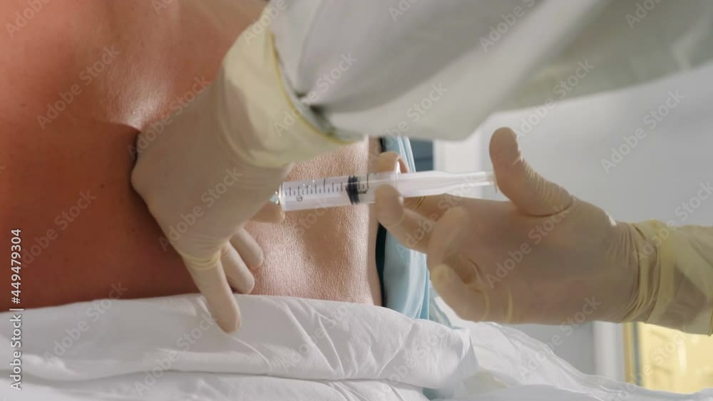 Spinal anesthesia injection, epidural anesthesia or nerve block. Anesthesiologist at work. Anesthesiologist or doctor holding epidural needle near patient back, Preparation for caesarean section or