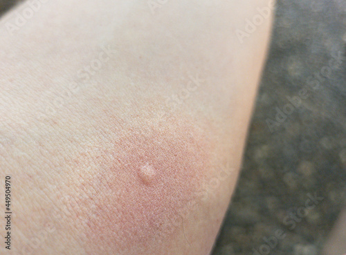 Close-up of skin with a mosquito bite and reddened skin