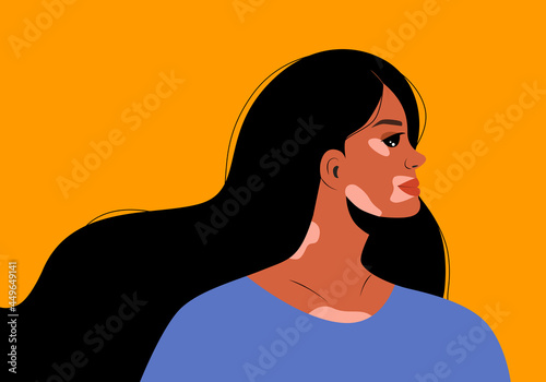 Portrait of an young woman with vitiligo in profile. Avatar of young girl with pigmentation on the skin. Vector illustration