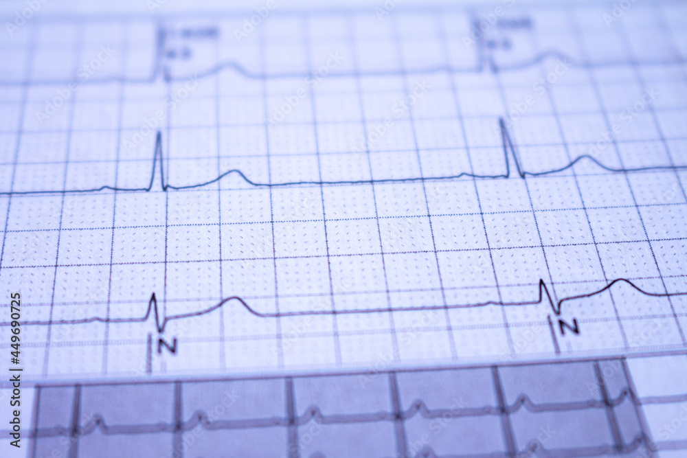 Close-up of an electrocardiogram with a heartbeat. Paper representation of heart arrhythmias.