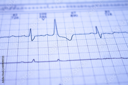 Close-up of an electrocardiogram with a heartbeat. Paper representation of heart arrhythmias.