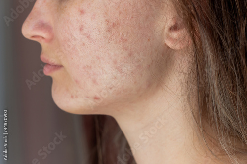 Cropped shot of a young woman's face in profile with problem of acne. Pimples, red scars on cheeks and chin. Allergies, dermatitis, rash. Problem skin, care and beauty concept.Dermatology, cosmetology