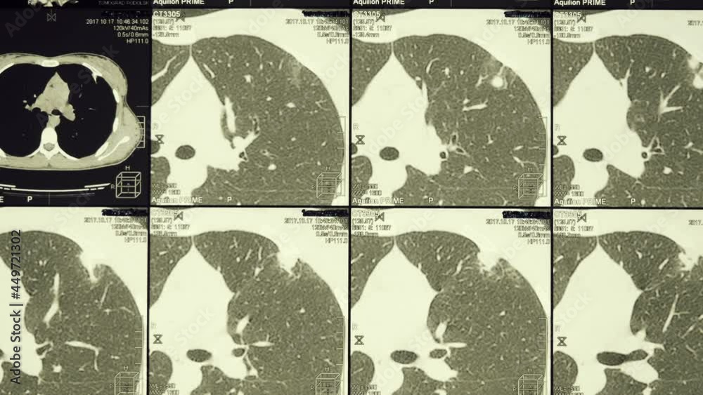 Magnetic resonance imaging (MRI) of the human chest with ribs, spine ...