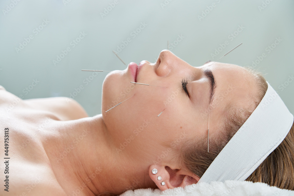 Young woman having an acupuncture treatment therapy on her face in spa salon. Alternative medicine and therapy concept - obrazy, fototapety, plakaty 