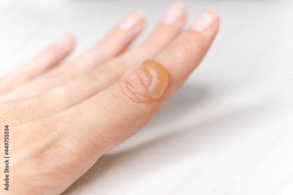 There is a blister on woman's hand from a burn. Burn of the finger. A