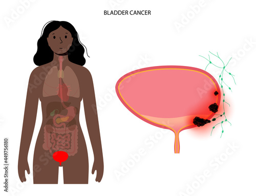 Bladder cancer stages
