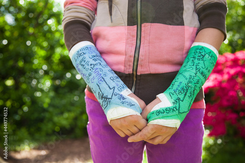 Girl (12-13) with two arm casts photo