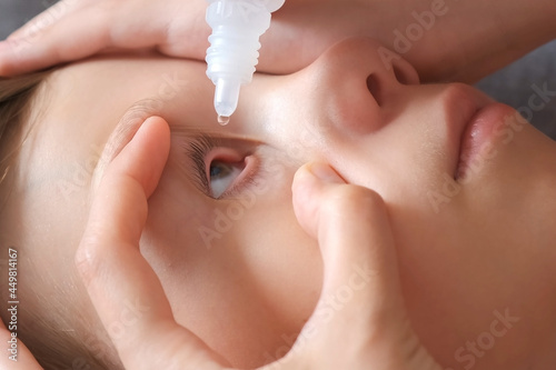 Woman instills eye drops in teen boy's eye, treating conjunctivitis and allergies, hands and face closeup. Allergy reaction to insect bites. Eye disease in a child, conjunctivitis, inflammation.