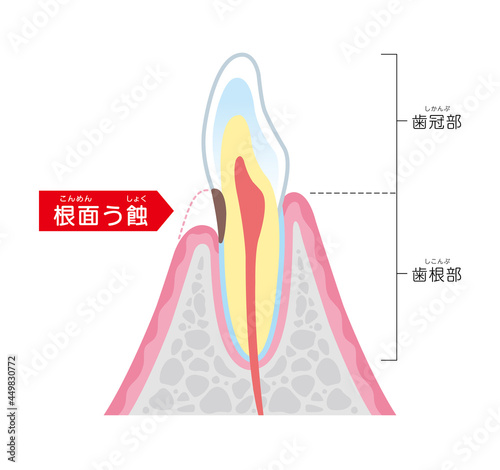 根面う蝕の図解イラスト