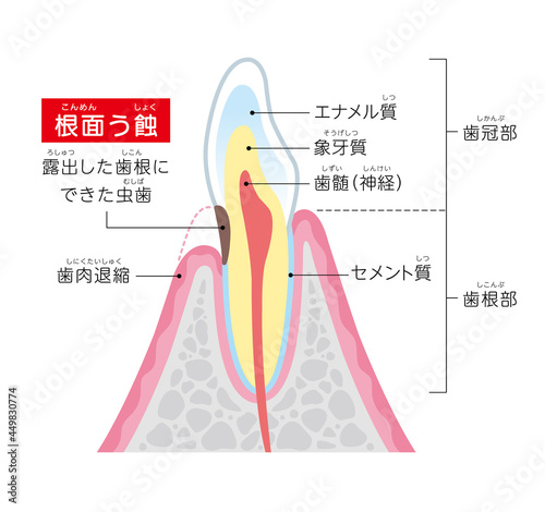 根面う蝕の図解イラスト