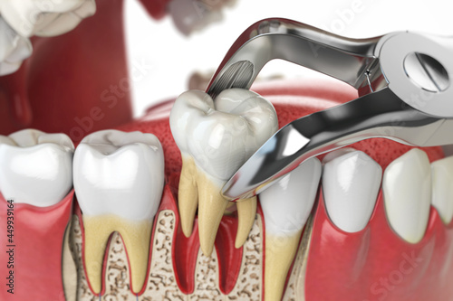 Tooth extraction by dental forceps on model of human jaw. 3d illustration photo
