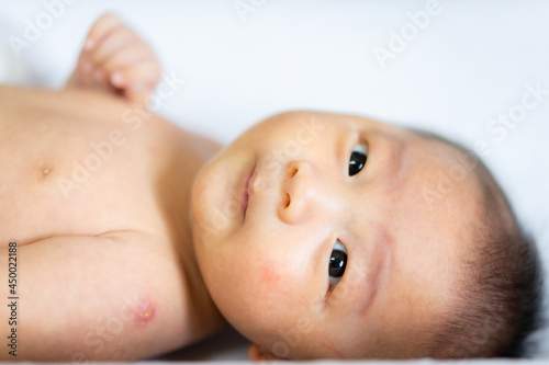 Asian baby on white bed with reaction of Bacillus Calmette Guerin or BCG vaccination on left shoulder. photo