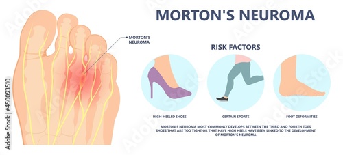 Morton's neuroma pain foot ball toe shoe tissue nerve High heel tight lump injury sport trauma deformity Hammer Bone spurs Flat feet arches Hallux Valgus Claw Mallet Pes Planus Cavus cyst tear wear