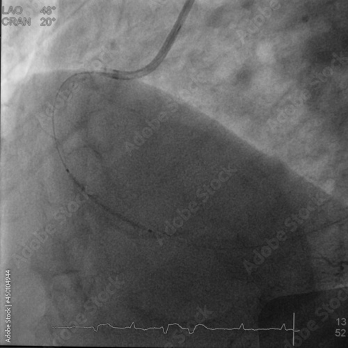 coronary angiogram (CAG) was performed percutaneous coronary intervention (PCI) at right coronary artery (RCA) photo