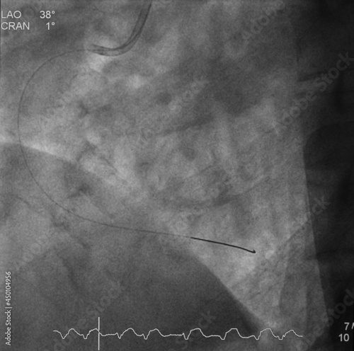 coronary angiogram (CAG) was performed percutaneous coronary intervention (PCI) at right coronary artery (RCA)
 photo