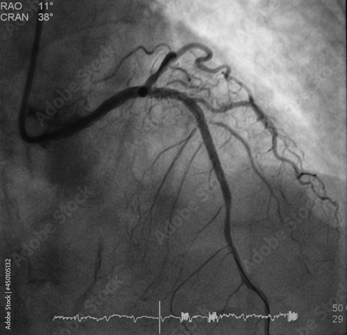 coronary angiogram (CAG) was performed post percutaneous coronary intervention (PCI) at mid part of left anterior descending artery (lad) photo