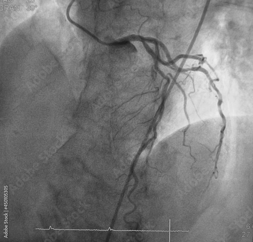 coronary angiogram (CAG) was showed left anterior descending artery (LAD) stenosis photo