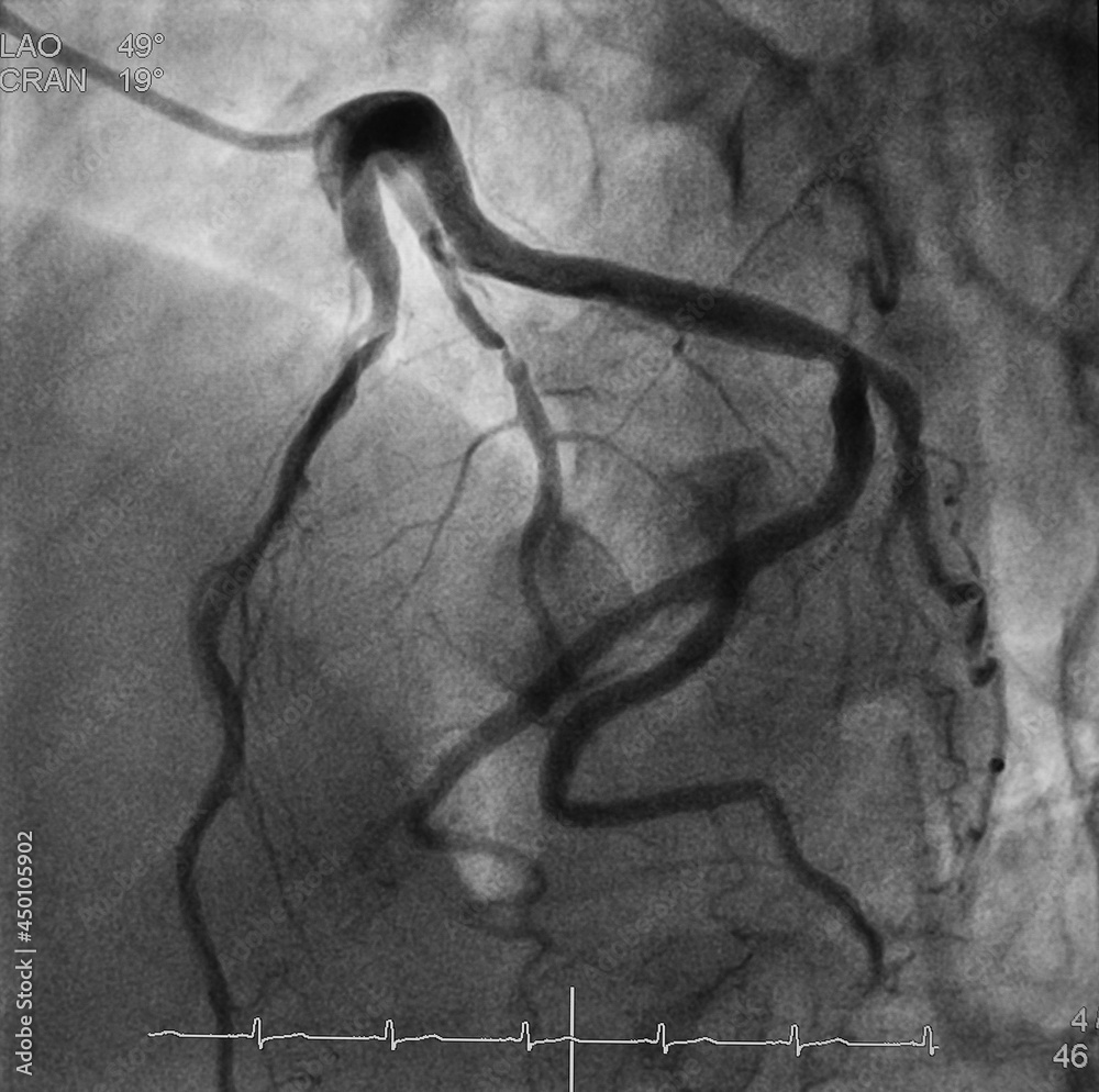 coronary angiogram (CAG) was showed left anterior descending artery ...