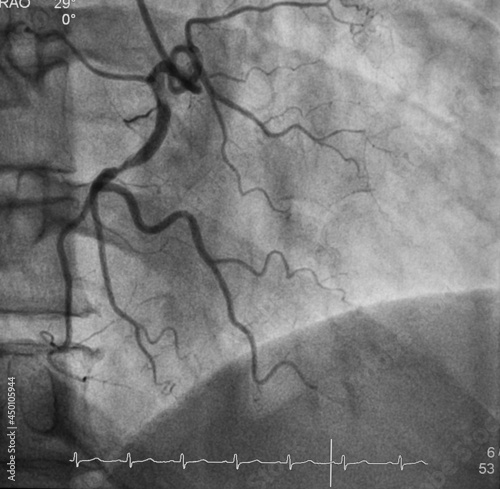 coronary angiogram was performed chronic total occlusion (cto) at mid right coronary artery (rca) photo