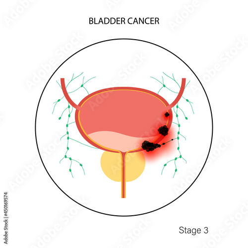 Bladder cancer stages