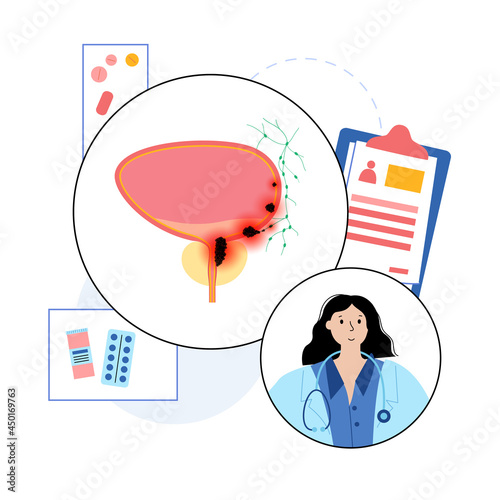 Bladder cancer stages