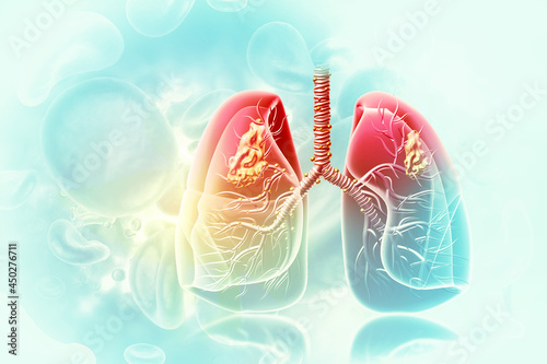 Murais de parede Medical Illustration showing lung cancer or bronchial carcinoma