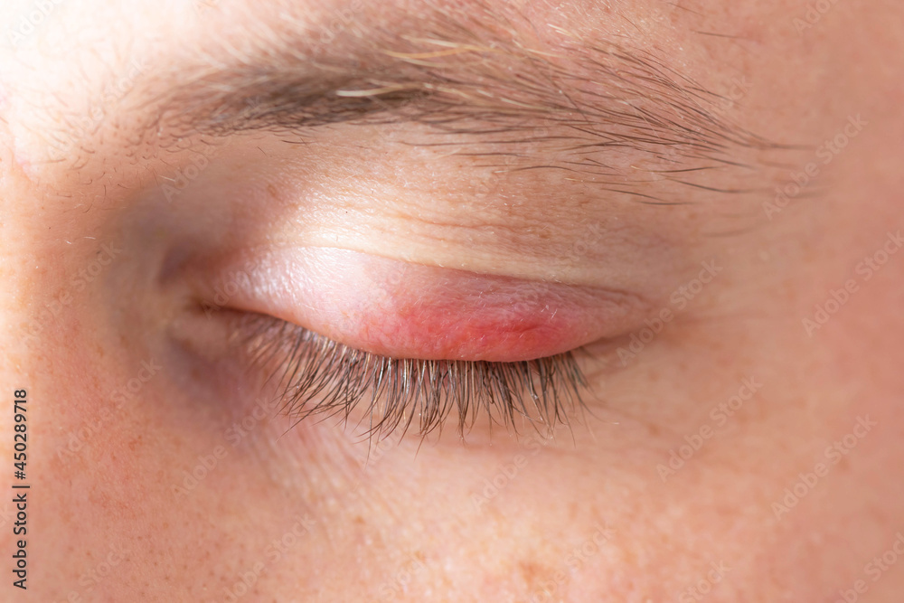 Fototapeta premium Swelling of the eye. Swollen upper lid. Close up.