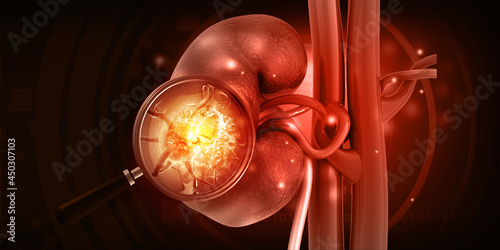 Acute pyelonephritis, kidney infection. 3d illustration. photo
