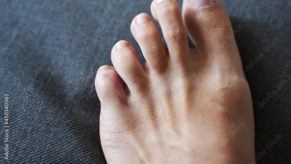 Foot little finger injury. Little toe pain and bruise after home accident. Phalange fracture