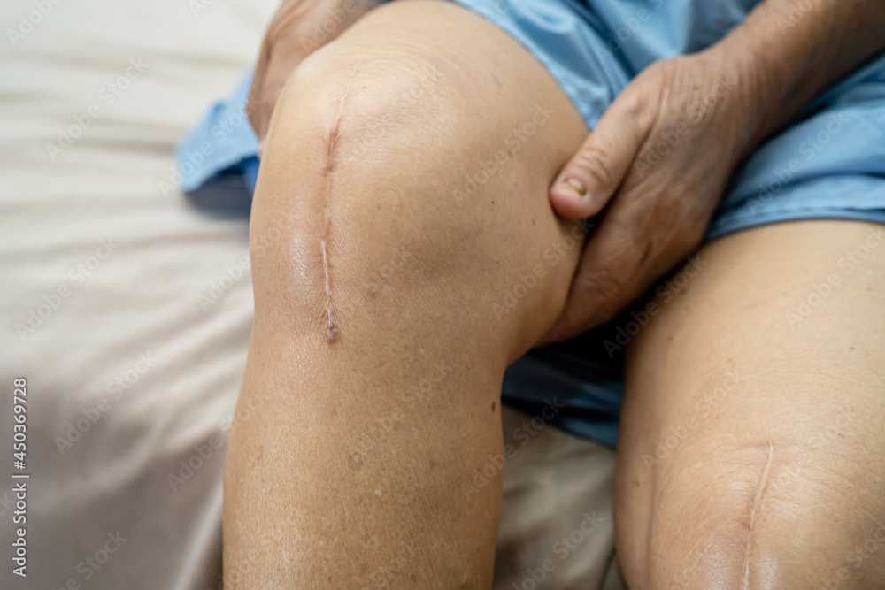 Asian senior or elderly old lady woman patient show her scars surgical total knee joint replacement Suture wound surgery arthroplasty on bed in nursing hospital ward, healthy strong medical concept. Asian senior or elderly old lady woman patient show her scars surgical total knee joint replacement Suture wound surgery arthroplasty on bed in nursing hospital ward, healthy strong medical concept.