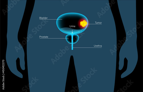 Bladder cancer stages