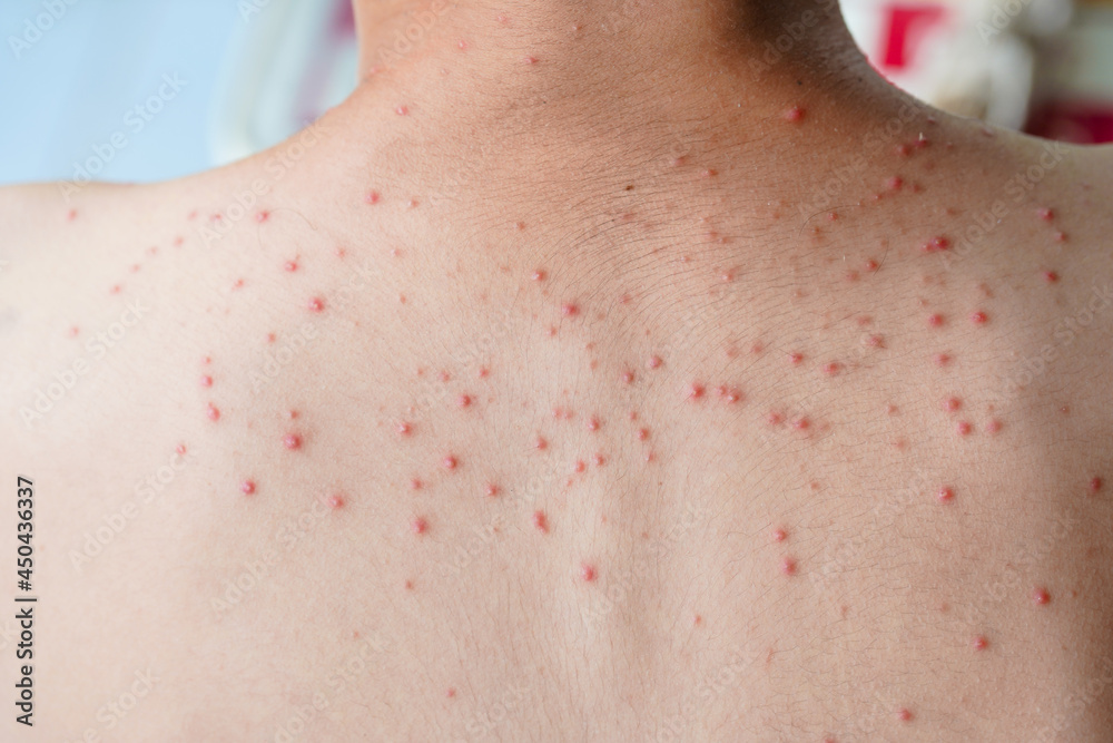 Fototapeta premium Acne on the back of a young man.