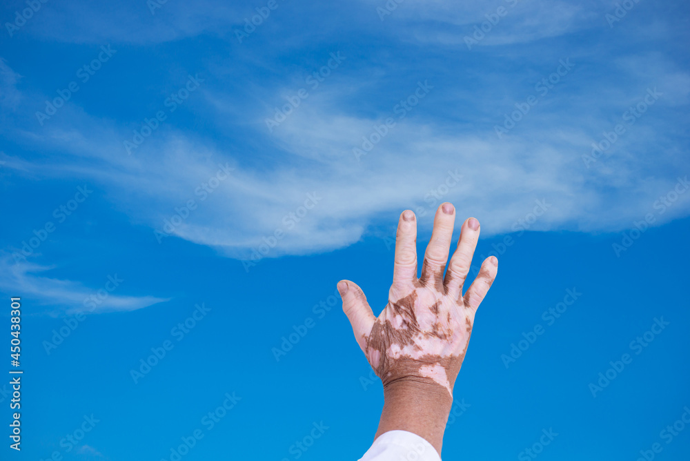 vitiligo hand on sky and clouds background vitiligo hand on sky and clouds background