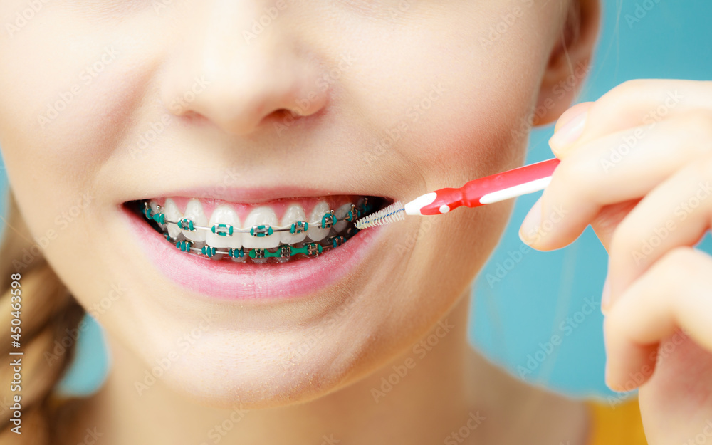 Woman with teeth braces using interdental brush Woman with teeth braces using interdental brush