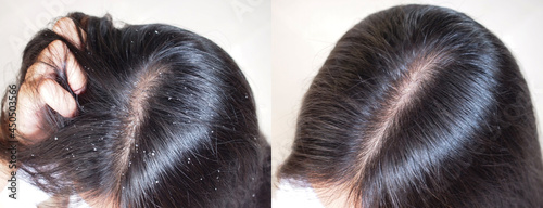 Image before and after anti dandruff treatment shampoo on hair woman.Problem health care concept. photo
