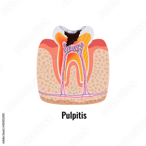 Dental Disease Poster