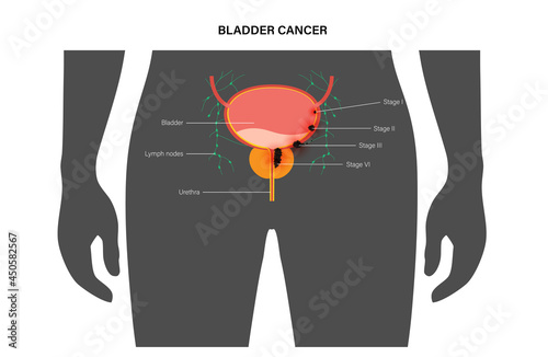 Bladder cancer stages