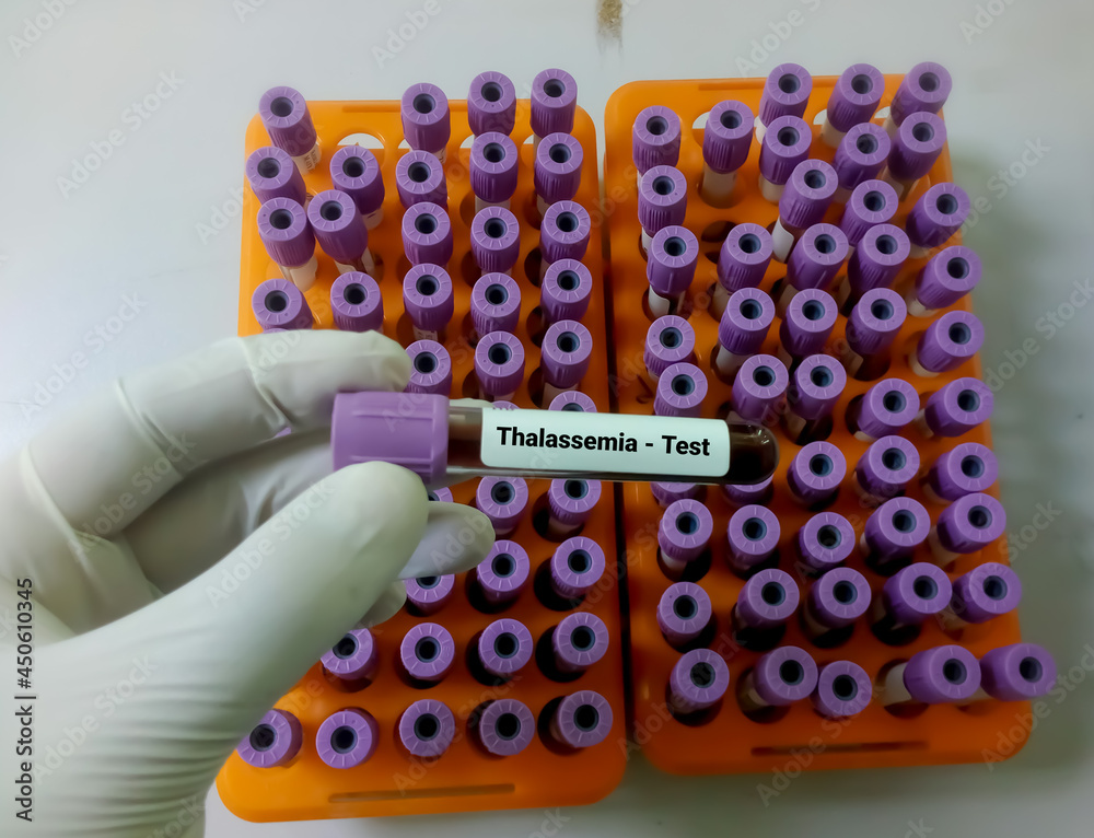 Blood sample for Thalassemia Test (alpha or beta). Hb electrophoresis
