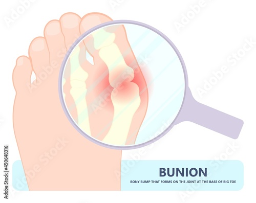 bony bump joint big toe bone enlarge fifth foot pain shoe Tailor swollen feet wearing poor fitting high heel Inversion lump bursa Hammer bend tendon stress injury gout spur callus corn turf flat feet