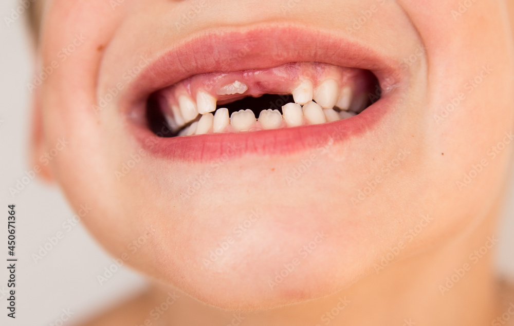Obraz premium The smile of a child who has lost a baby tooth. Care for children's teeth.