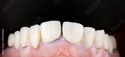 press ceramic crowns and veneers bl2