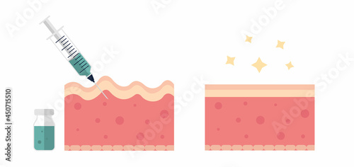 Skin with wrinkles and fine line before and after injection flat illustration. Dermatology, collagen, rejuvination concept. For topics like anti-aging therapy, biorevitalization and mesotherapy photo