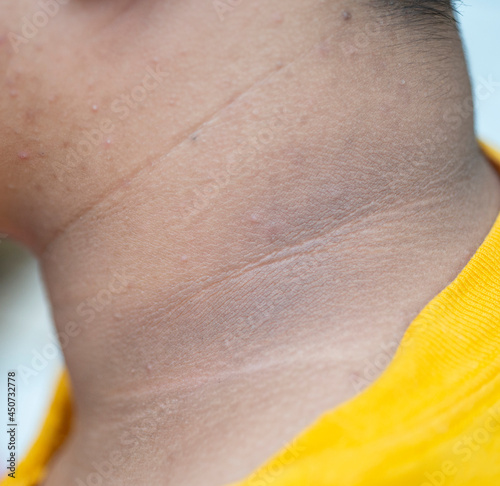 фотографія The skin of the person with the blotches is darker than the normal skin color on the neck