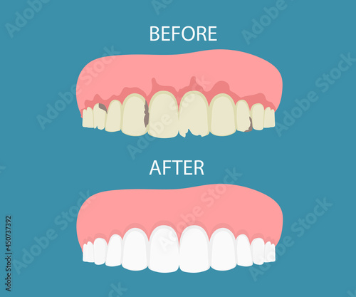 Dental dental treatment on a . Before and After, whitening oral care concept. Deep cleaning, clearing tooth process. illustration. vector. flat