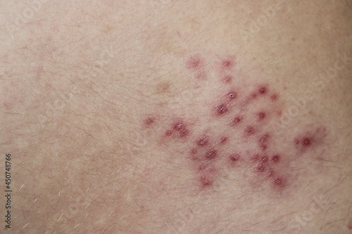 close up of shingles rash blisters flaking 