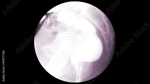 Barium enema image of large bowel after injection of barium contrast fill into colon under fluoroscopic control isolated on white background.