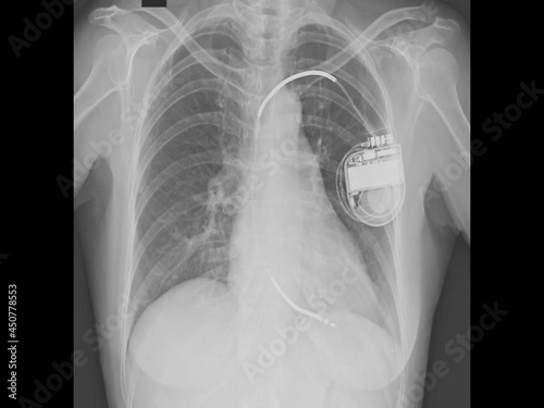 x-ray image of permanent pacemaker implant in body chest.
