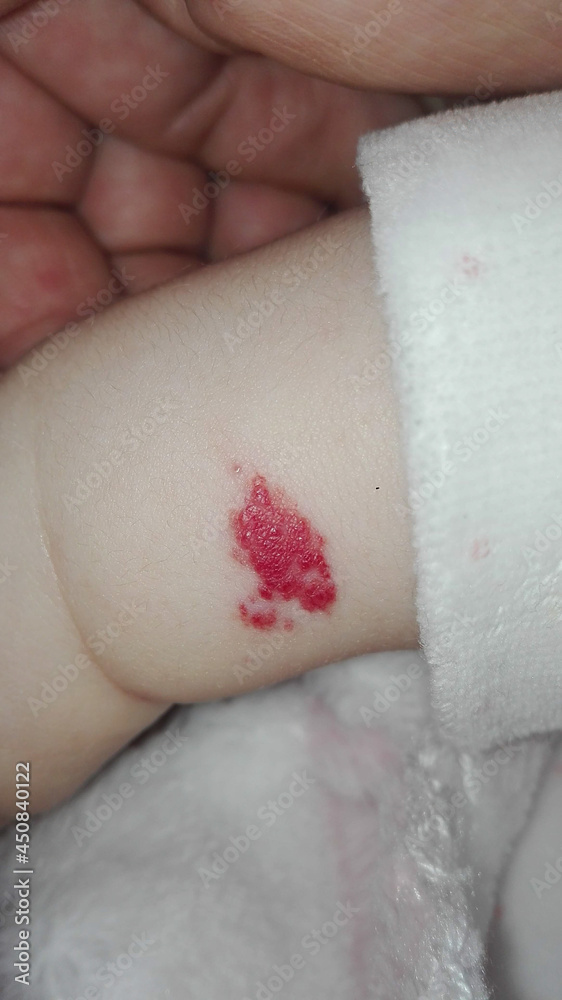 Fototapeta premium Angioma or pink hemangioma on a baby's arm